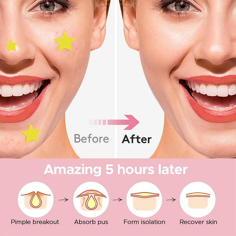 600 PCS/SET Star Pimple Patch Acne Colorful Invisible Acne Removal Skin Care Stickers Concealer Face Spot Beauty Makeup Tools - Tasawoq